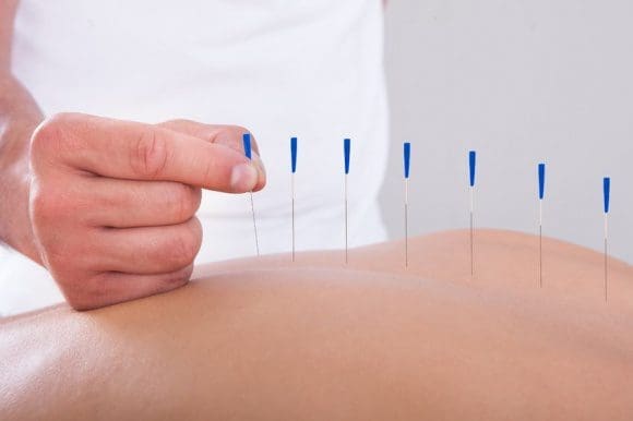 Acupuncture Herniated Discs - El Paso Chiropractor