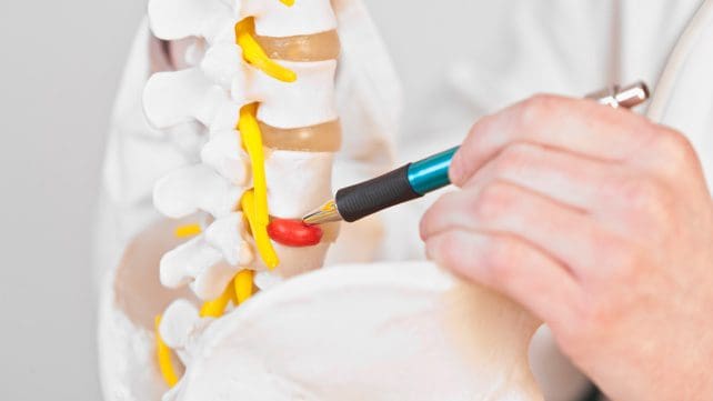 Scientific Chiropractor: Herniated Disc Signs and Symptoms