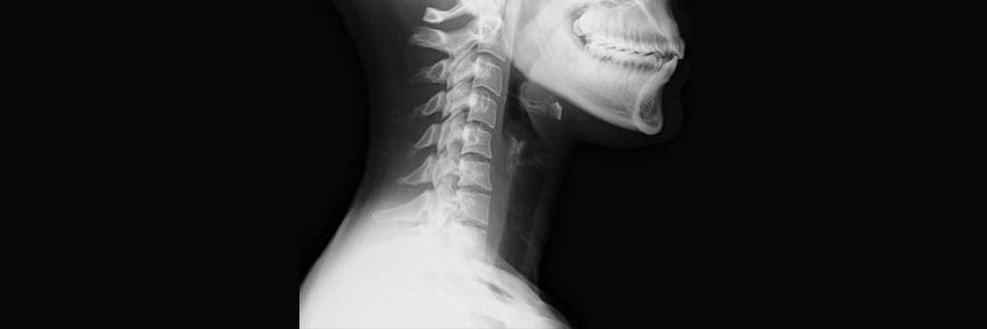 Loss of Cervical Curvature from Motor Vehicle Crashes - El Paso Chiropractor