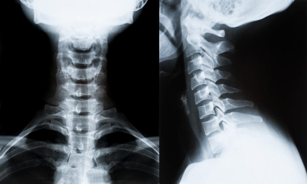 Whiplash Chiropractor: Loss of Cervical Lordosis - El Paso Chiropractor