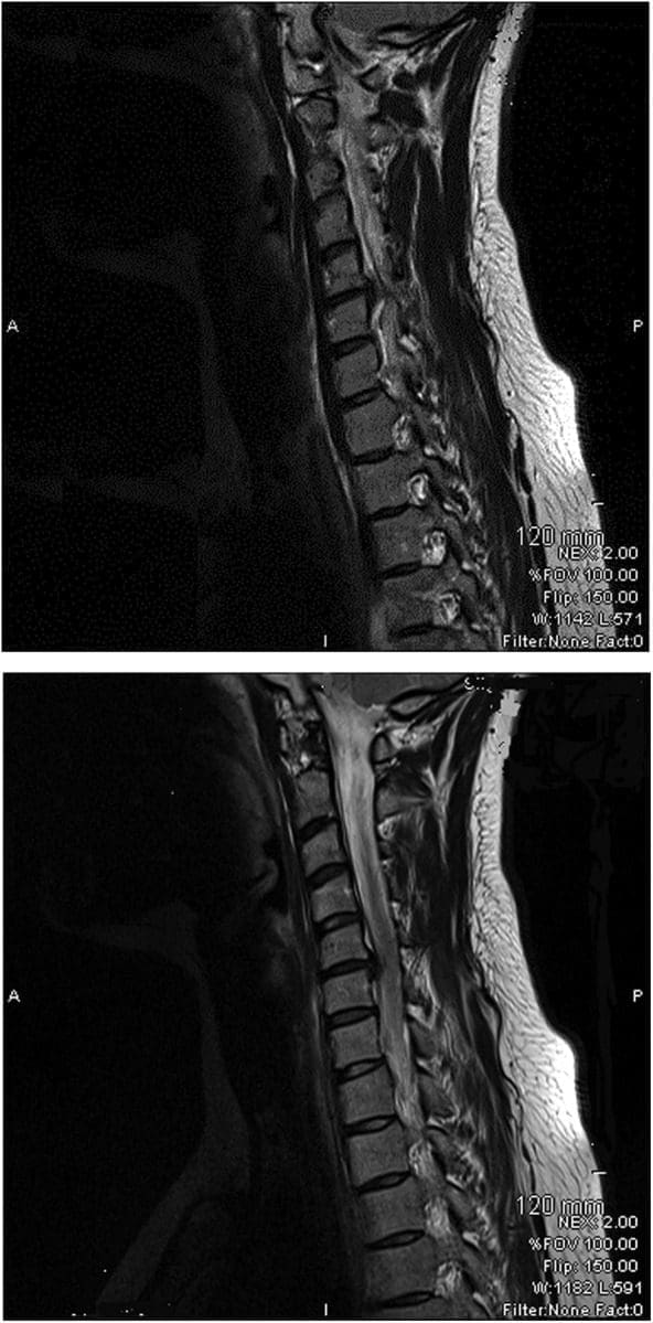 Figure 1 Loss of Cervical Spine Lordosis and Large Disc Herniation at C5 and C6 on MRI
