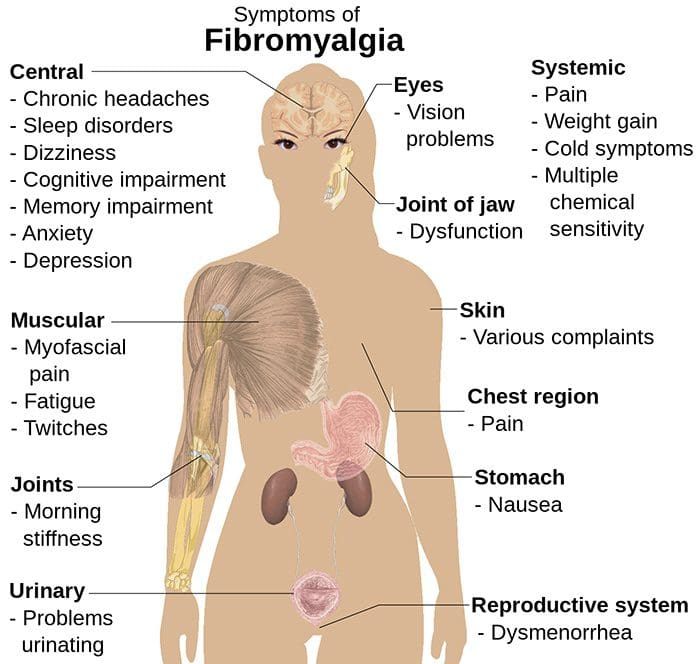 fibromyalgia syndrome