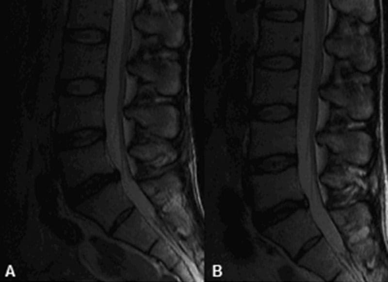 Figure 7 Magnetic Resonance Images of the Structural Changes of the L5 - S1 Spinal Disc | El Paso, TX Chiropractor