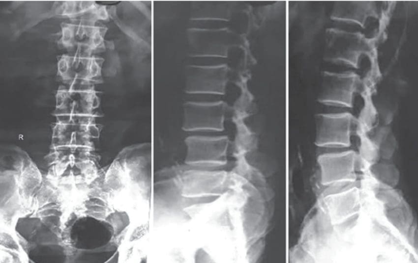 Classifying Spondylolisthesis After a Personal Injury | El Paso, TX Chiropractor
