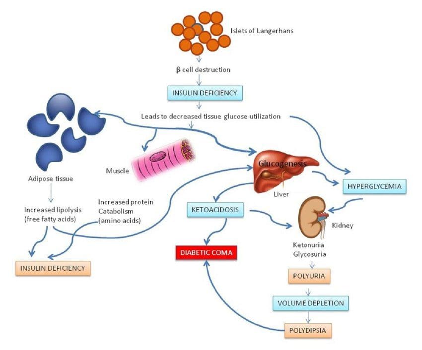Pathophysiology-of-type-1-diabetes